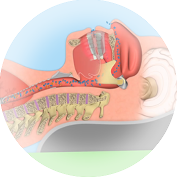 <p>What is Myosa<sup>®</sup>?</p>